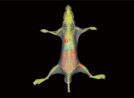 Lung Cancer with Bone Metastasis