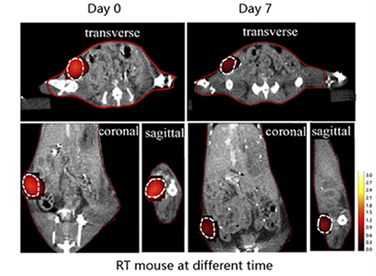 Evaluation of Radiotherapy Efficacy for Breast Cancer