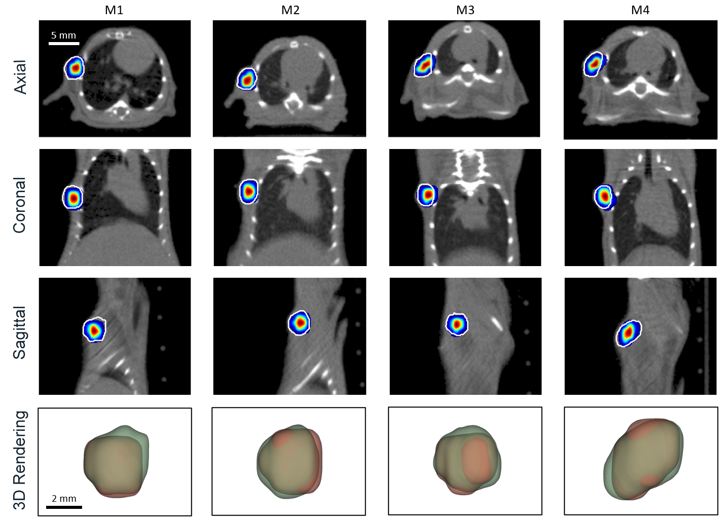 Tumor Images in Axial, Sagittal, Coronal Planes with 3D Rendering